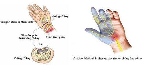 Tê bàn ngón tay là bệnh gì và chữa ở đâu?