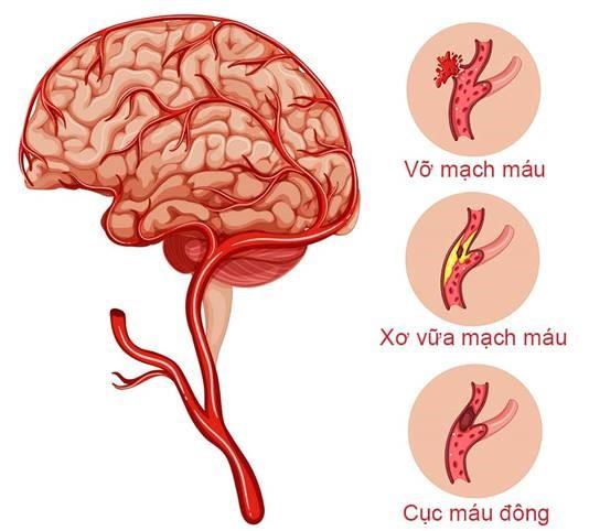 Đột quỵ: Nguyên nhân, dấu hiệu nhận biết, cách phòng tránh