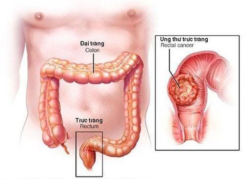 Ung thư hậu môn là một sự phát triển bất thường của các tế bào hậu môn gây nguy hiểm tới tính mạng