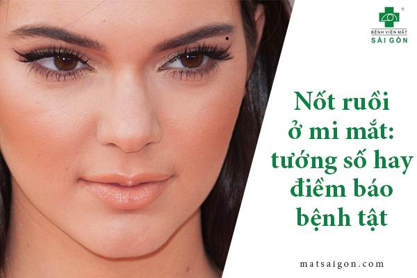 Nốt ruồi ở mi mắt: ý nghĩa tướng số hay điềm báo bệnh tật