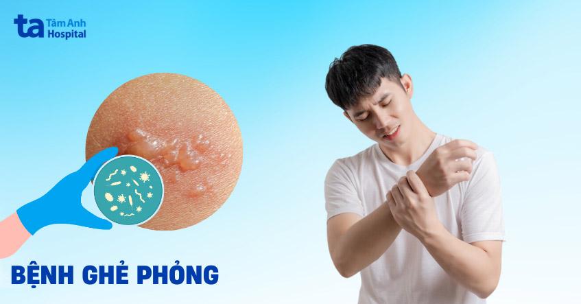 Bệnh ghẻ phỏng: Nguyên nhân, triệu chứng, điều trị, phòng ngừa